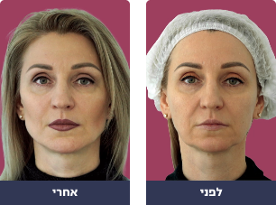 Pictures before and after