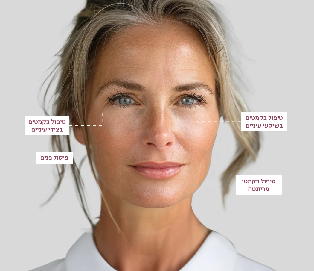 טיפול בקמטים בשיקעי עיניים, טיפול בקמטי מריונטה, טיפול בקמטים בצידי עיניים, פיסול פנים